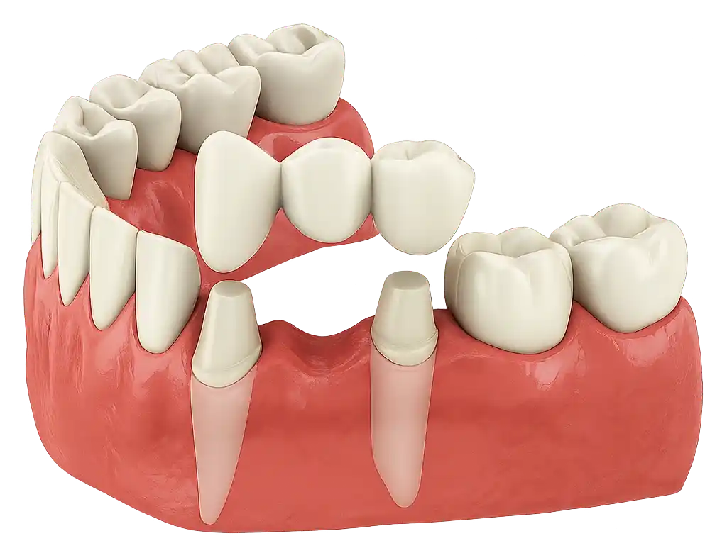 Anatomical dental model demonstrating placement of crowns and a dental bridge for restoring missing and damaged teeth
