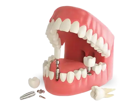 Upper and lower denture model used for implant consultation – Best Dental Implant in Nagpur