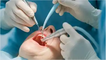 Apicoectomy surgery image to treat root infections performed by Dr. Rahul Atara