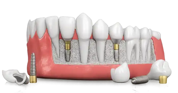 Dental Model for Education Educational dental implant model used for general dentistry consultation in Nagpur