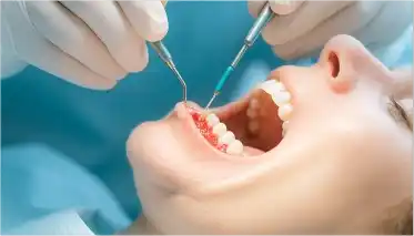 Dental surgery to restore jawbone structure and improve smile aesthetics at KinSmile