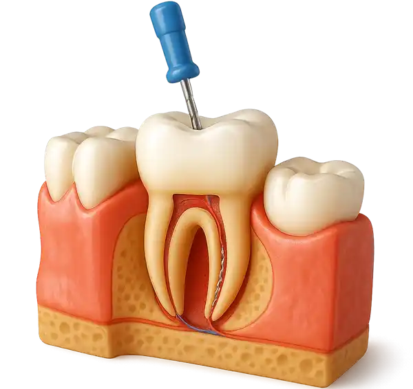 Dental implant procedure Single tooth with dental implant screw positioned above the gum